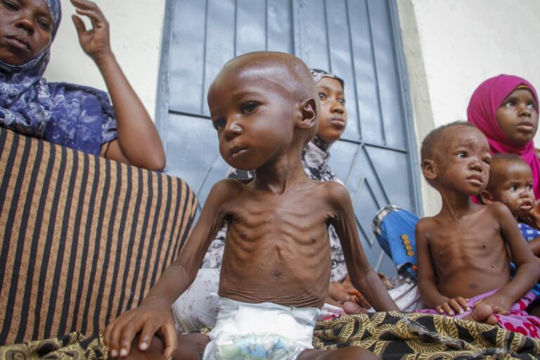 UN warns of deepening child malnutrition in Somalia as foreign aid drops
